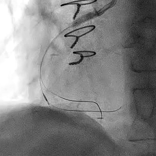 Real angiographic frame from a chronic total occlusion case. A guidewire follows the vessel course in a flat grayscale projection.